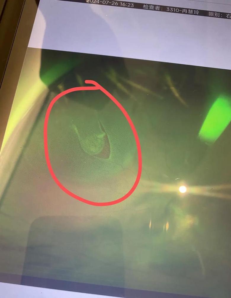 视觉模糊与突然失明：解析常见视觉症状及应对方法