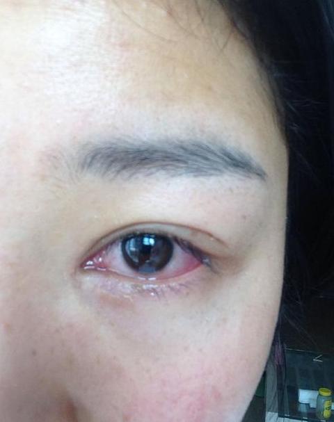 眼睛出现白雾原因揭秘及预防措施